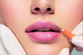 Facts about lip fillers